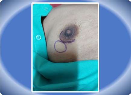 FIBROADENOMA BREAST
